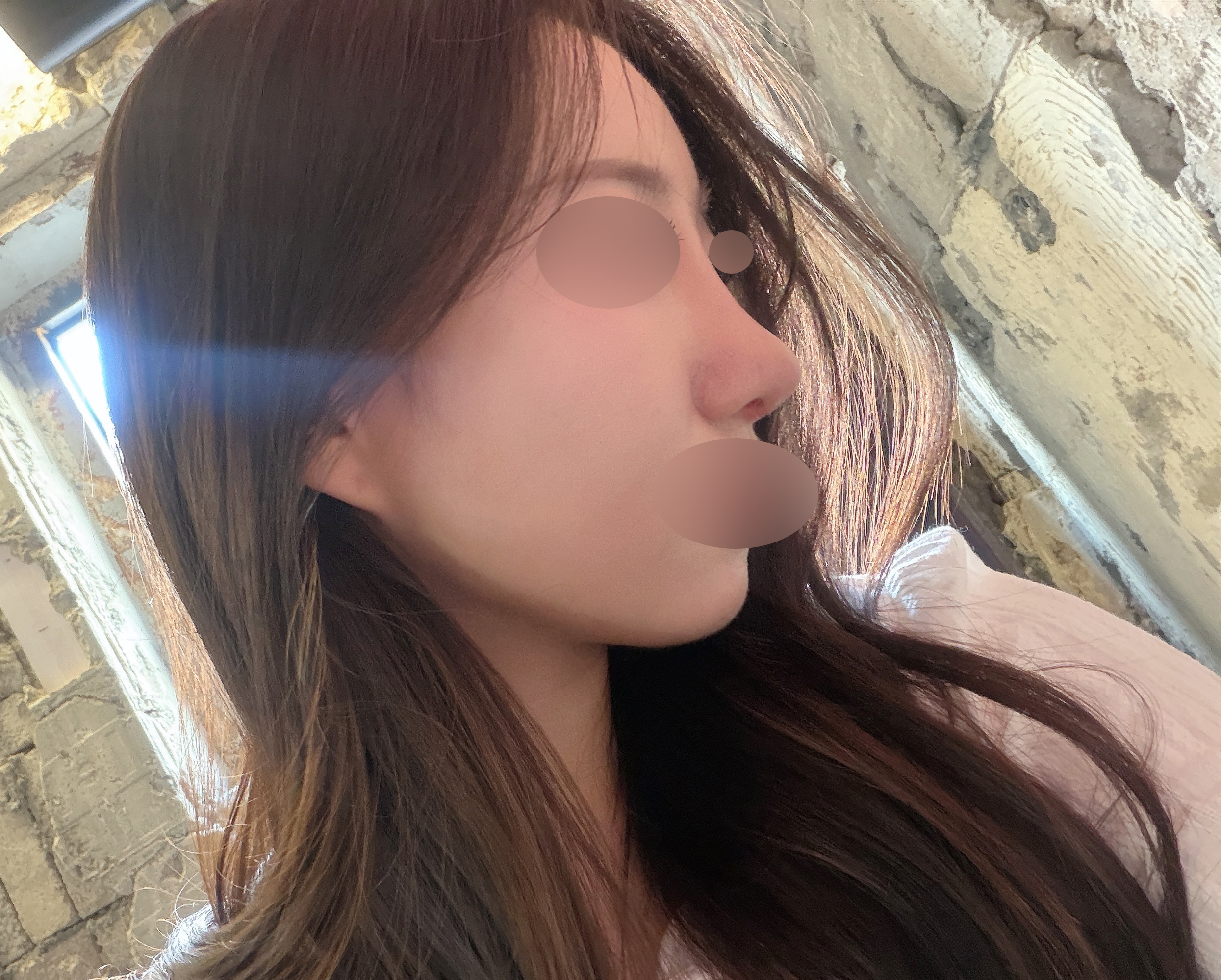 수술후기이미지