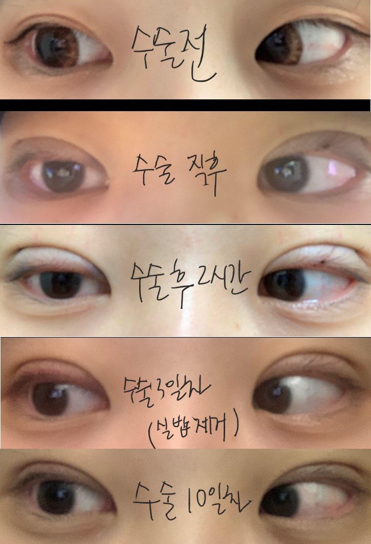 수술후기이미지