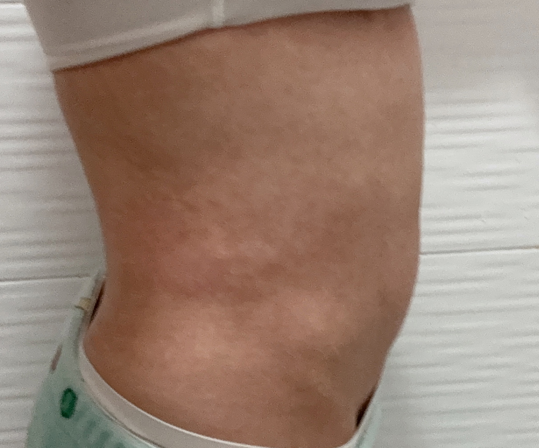 상하복부·옆구리 지방흡입 2주차, 점점 달라지는 복부 라인~^^