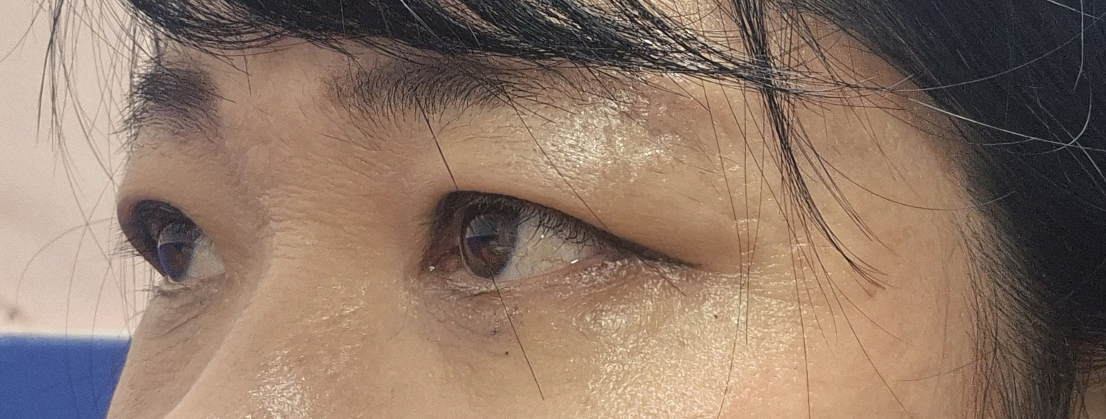 수술후기이미지