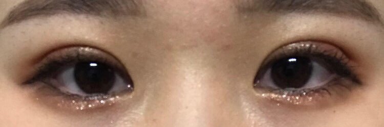 수술후기이미지