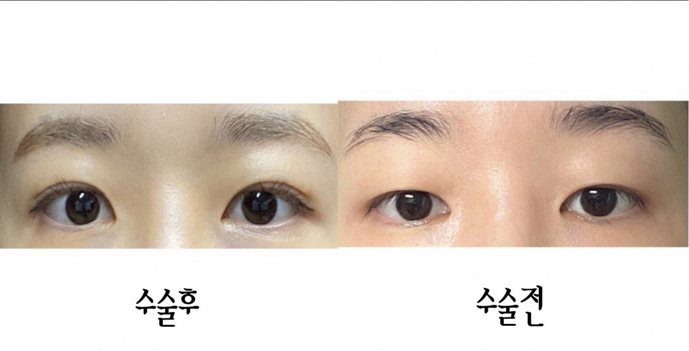 수술후기이미지