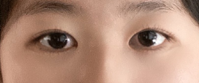 수술후기이미지