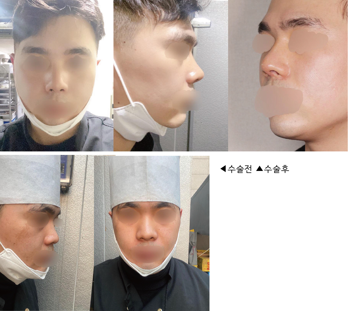 수술후기이미지