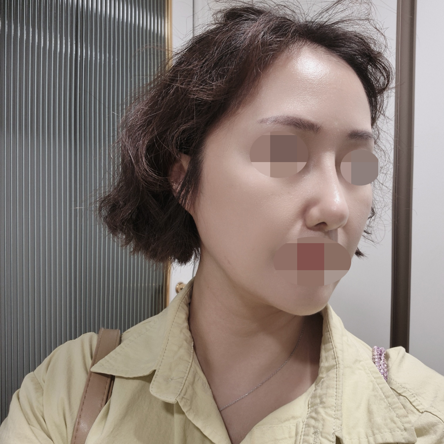 코성형 1달차, 자연스러운 변화가 가장 마음에 들어요