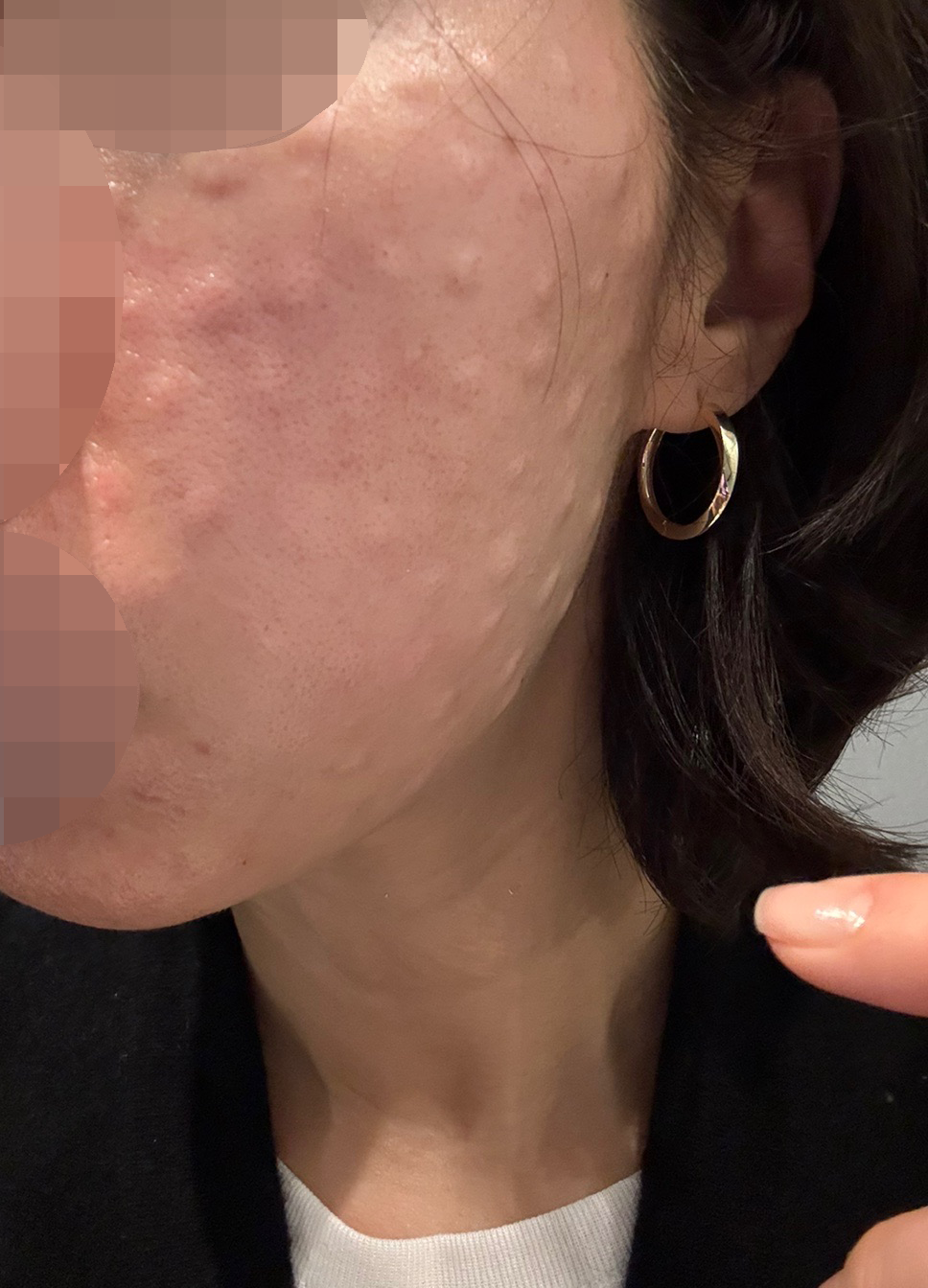 수술후기이미지