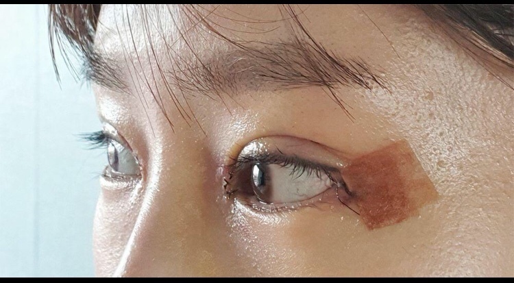 수술후기이미지