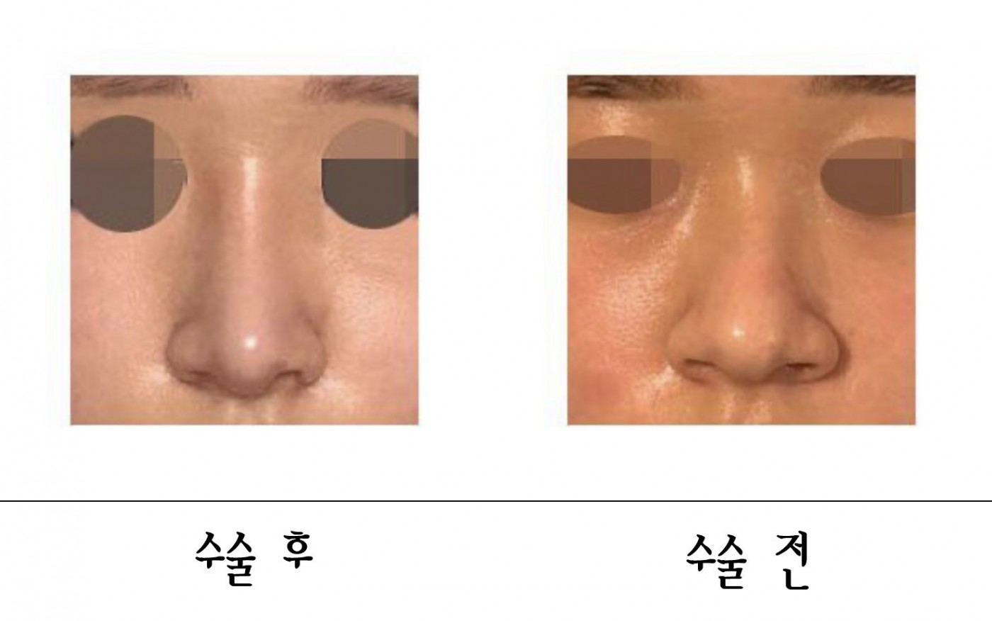 수술후기이미지