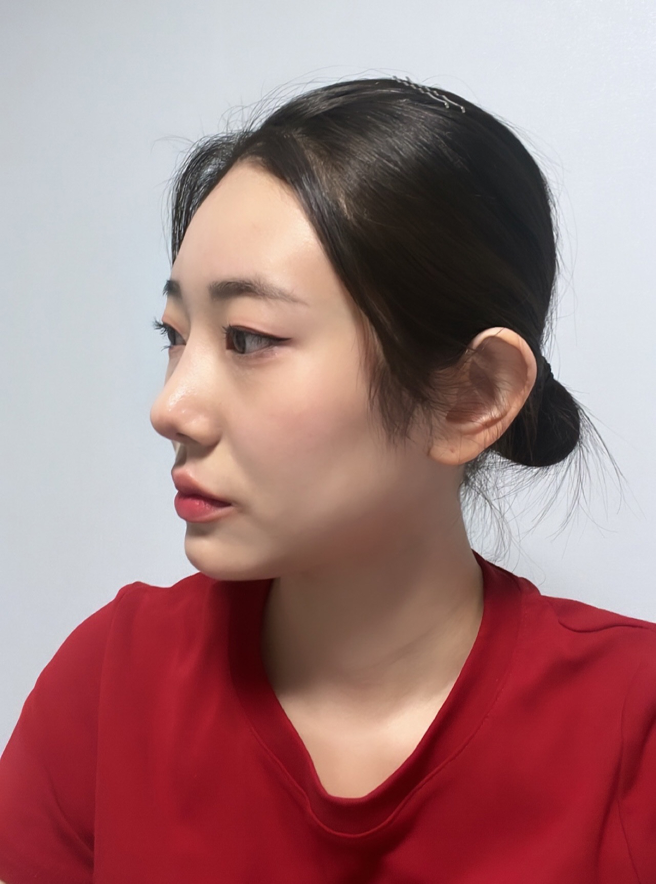 수술후기이미지