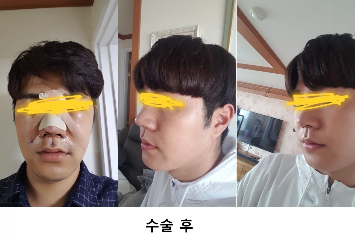 수술후기이미지