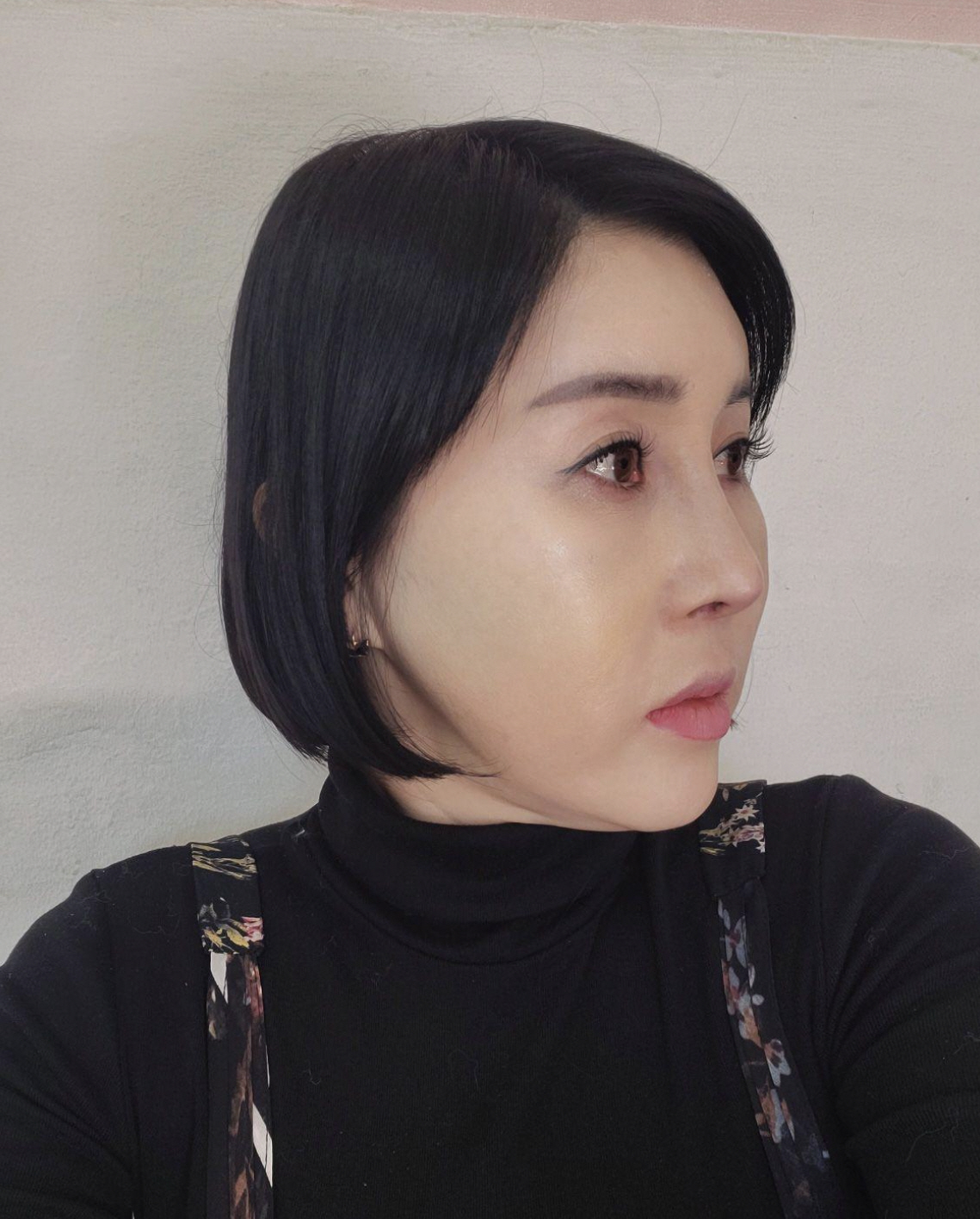 수술후기이미지