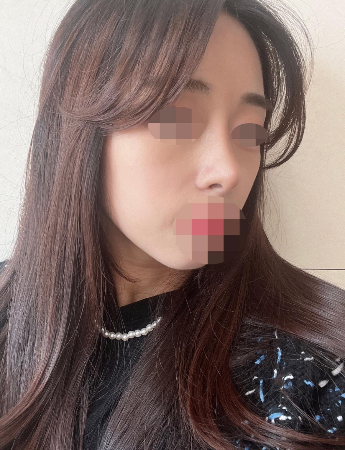 수술후기이미지