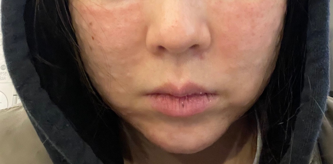 수술후기이미지