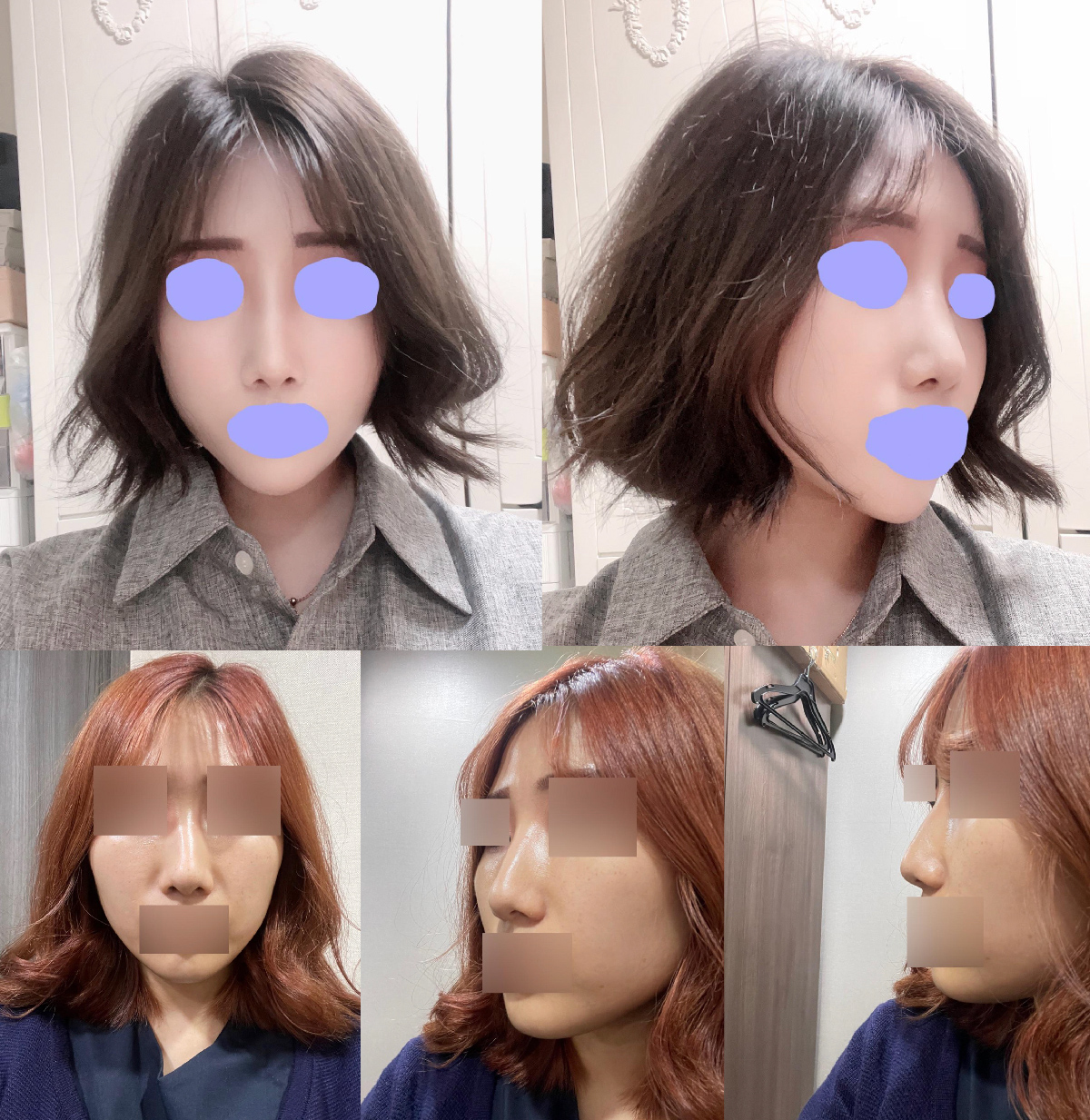 수술후기이미지