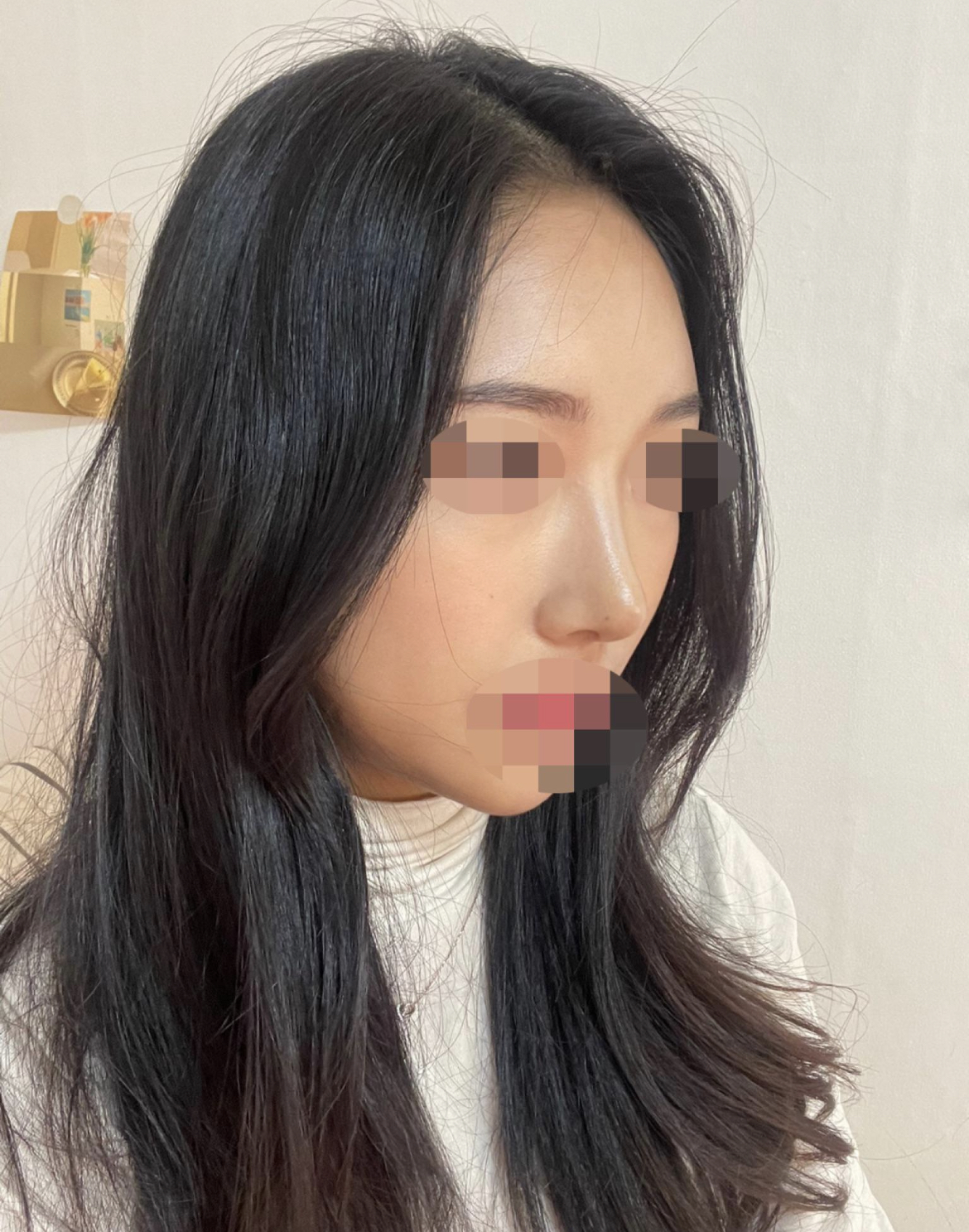 수술후기이미지