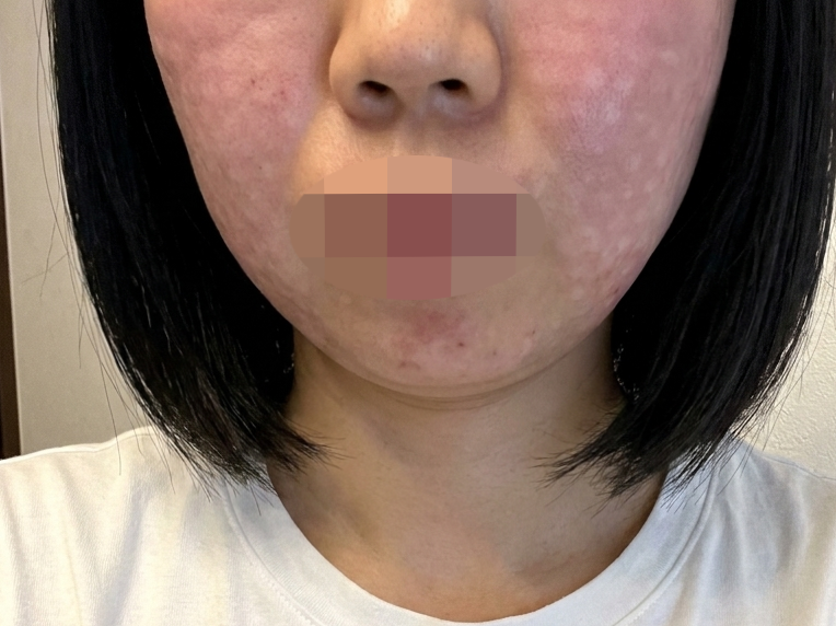수술후기이미지