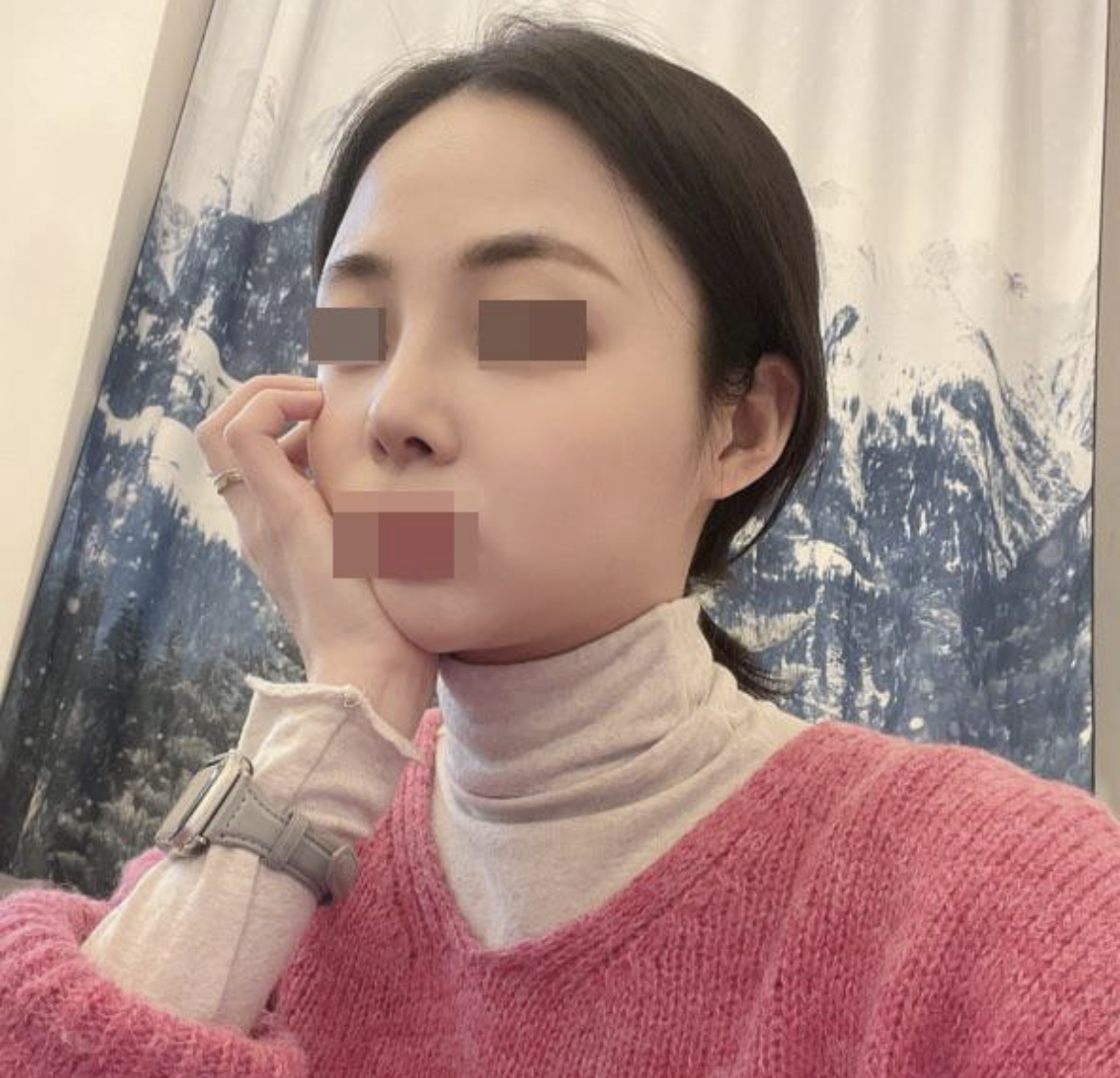 수술후기이미지