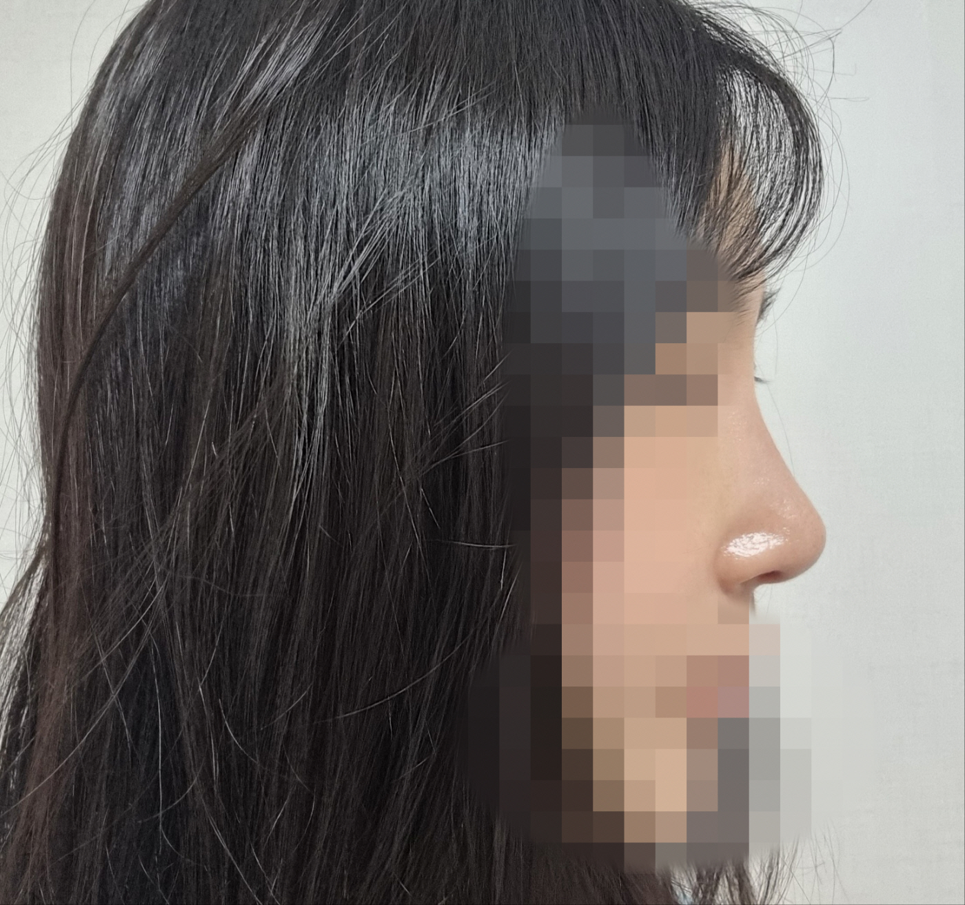 수술후기이미지