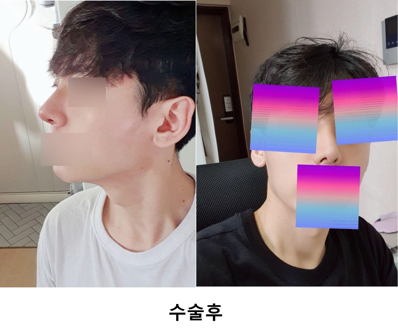 수술후기이미지