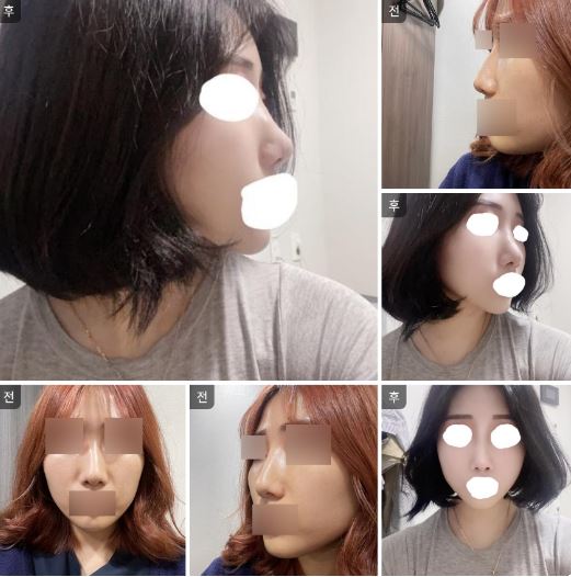 수술후기이미지