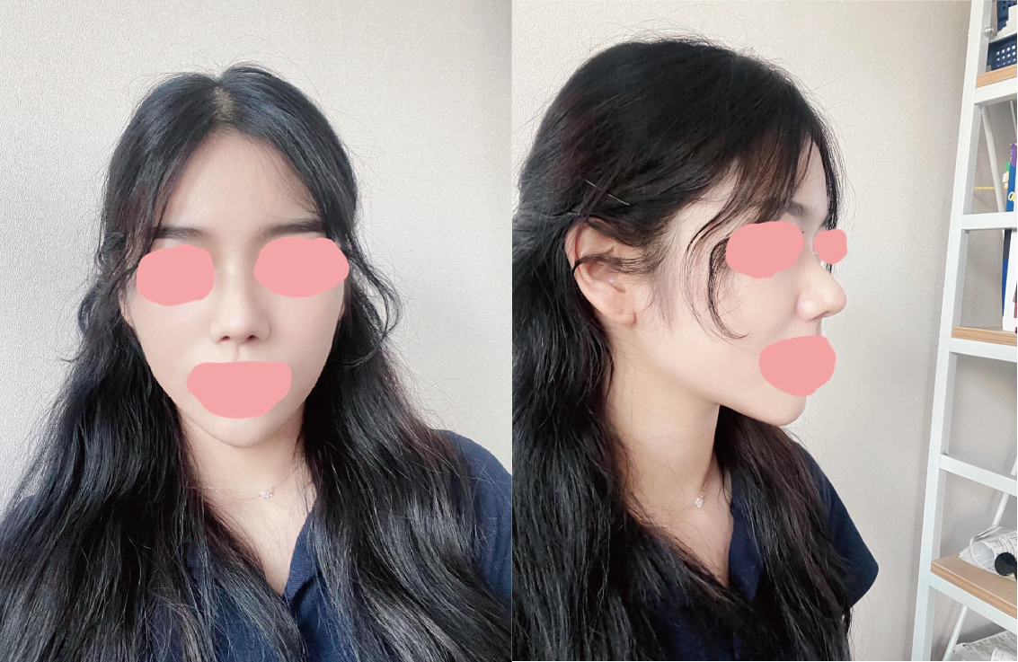 수술후기이미지