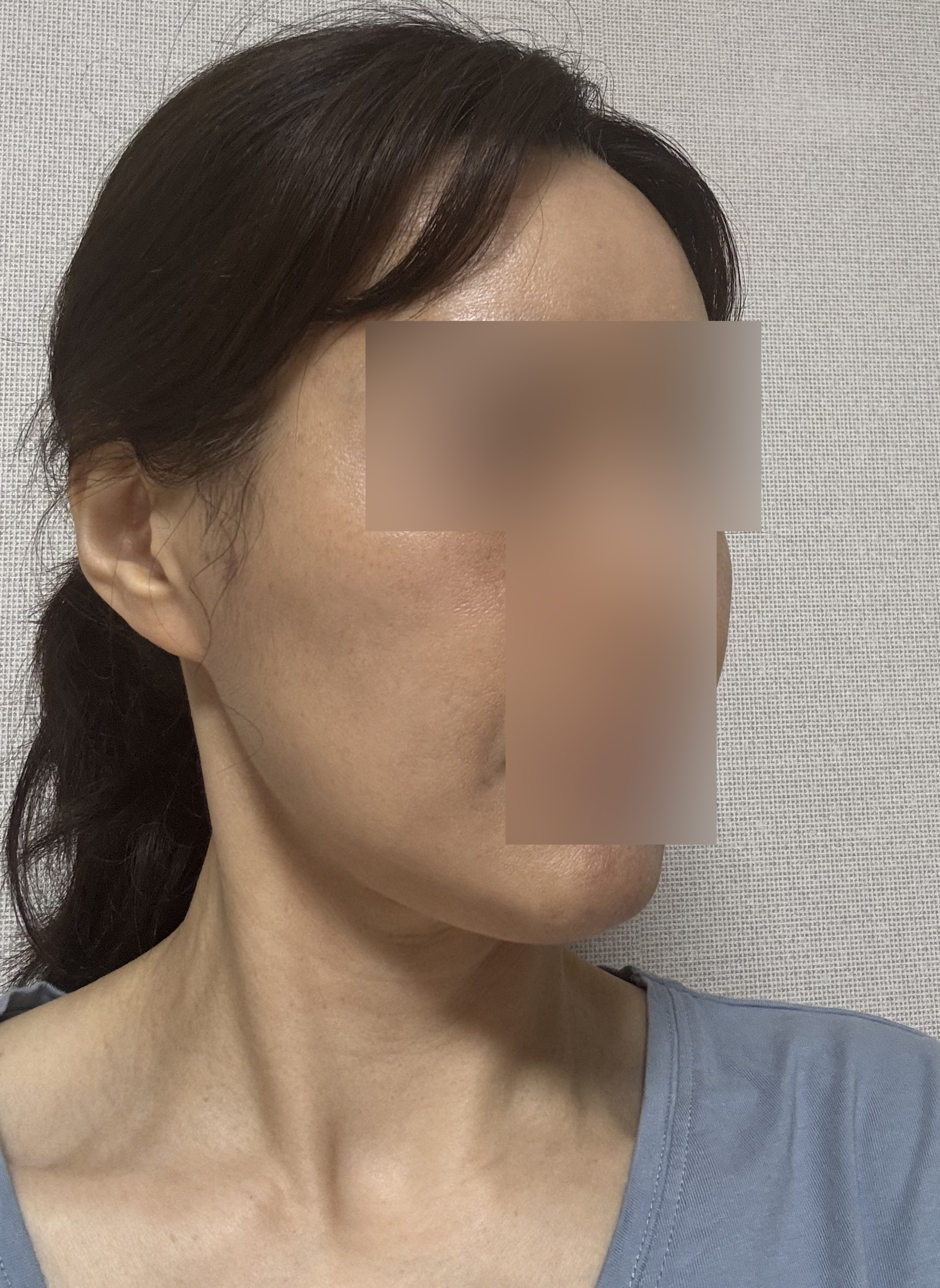 수술후기이미지