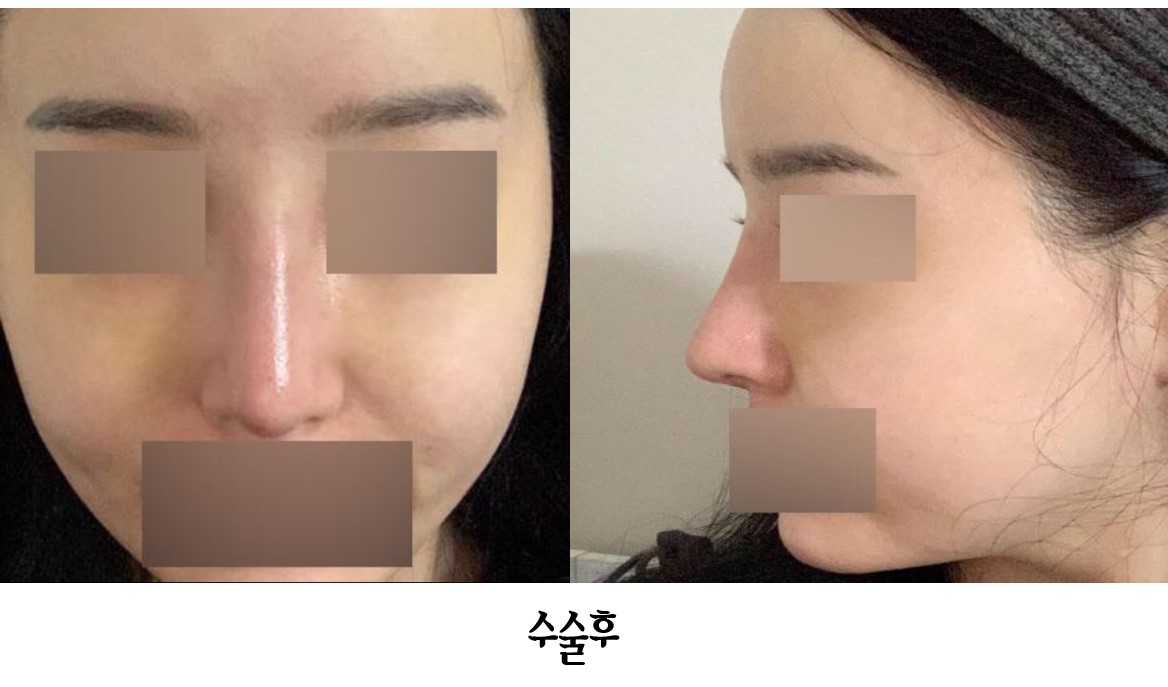 수술후기이미지