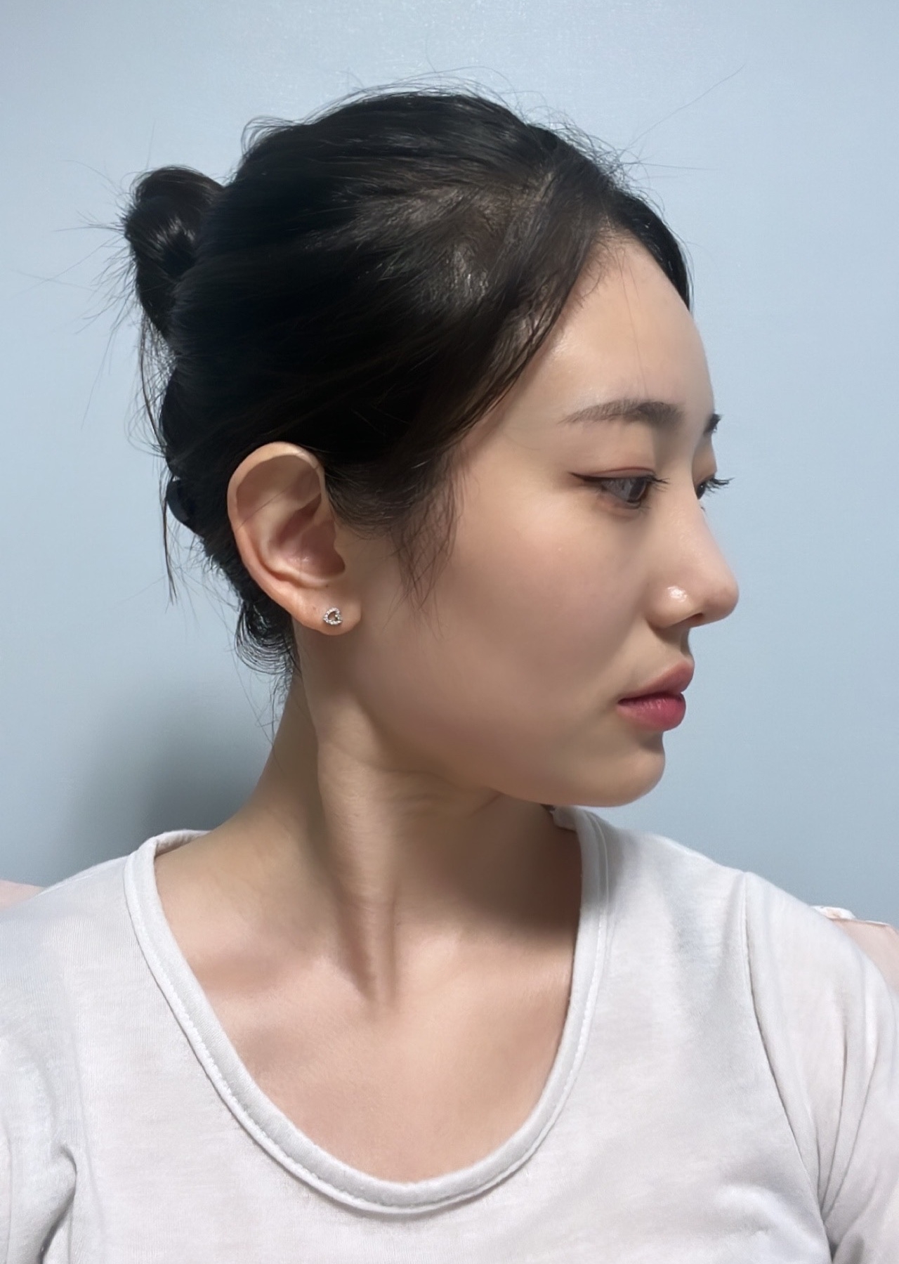 수술후기이미지