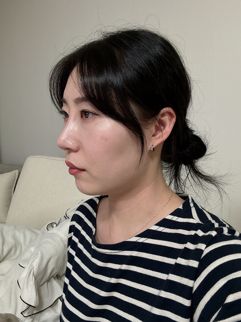 수술후기이미지