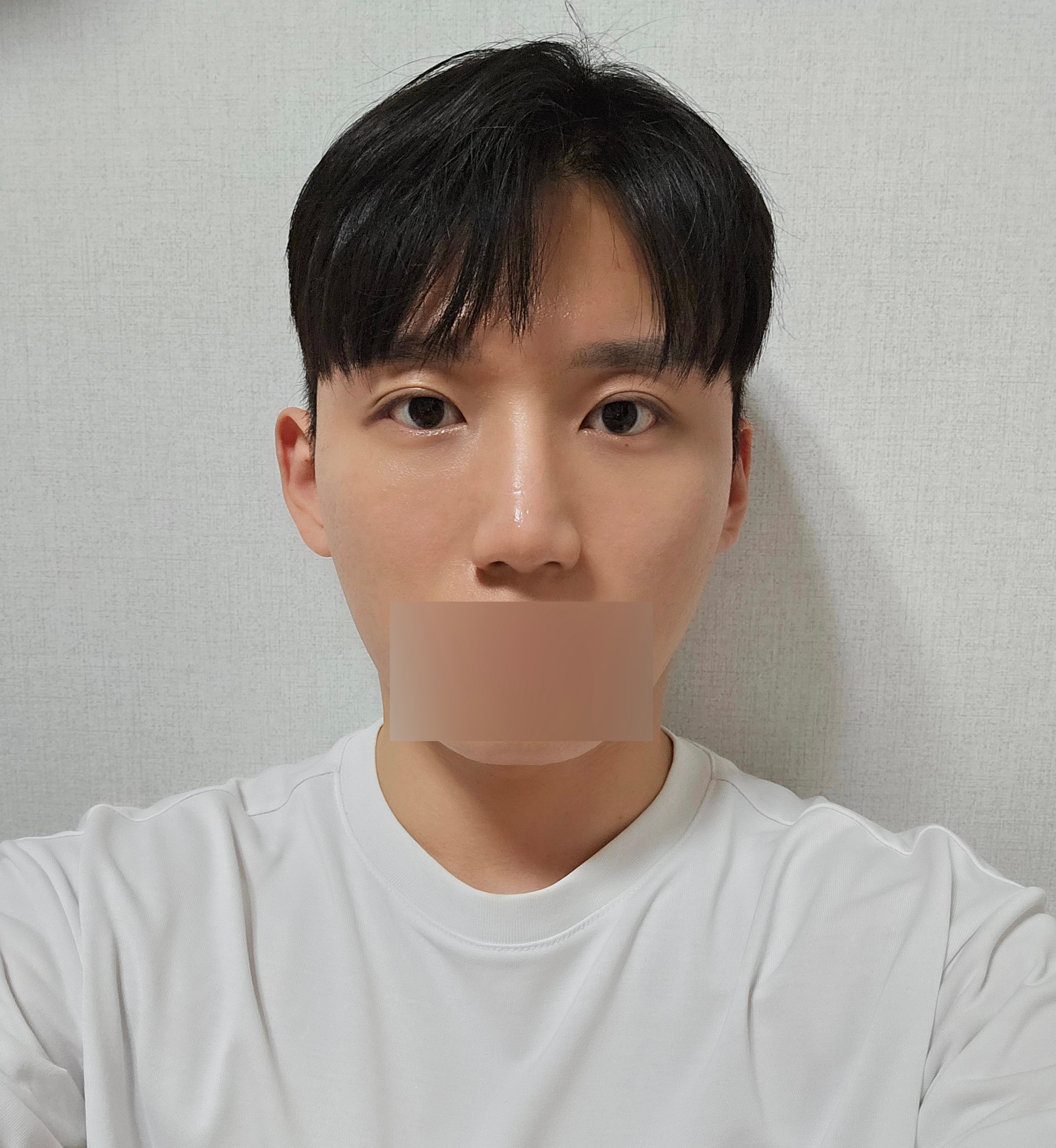 수술후기이미지