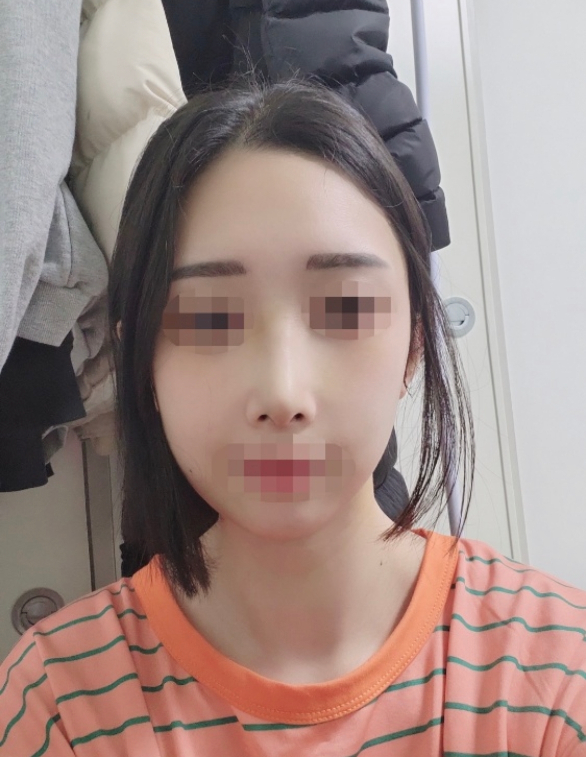 수술후기이미지