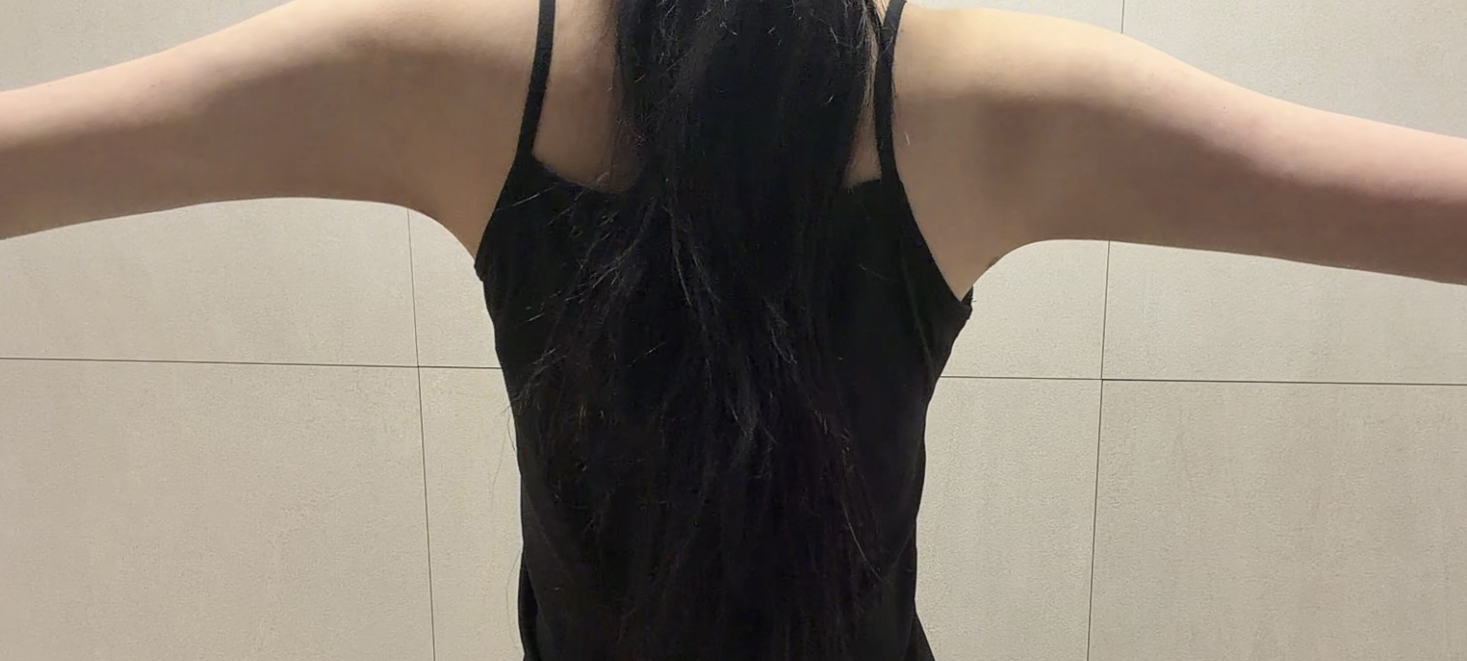 팔+견갑 지방흡입 2달차, 민소매도 자신 있게 입어요!