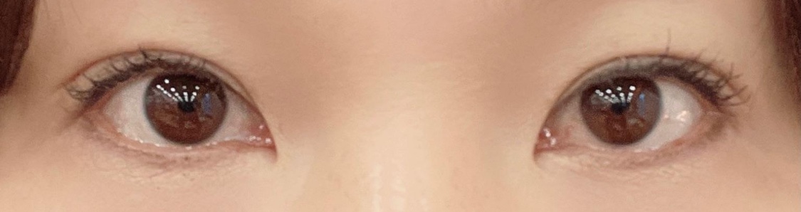 수술후기이미지