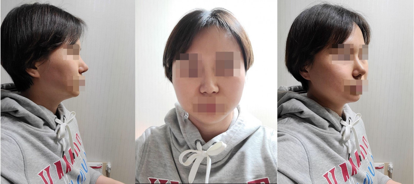 수술후기이미지