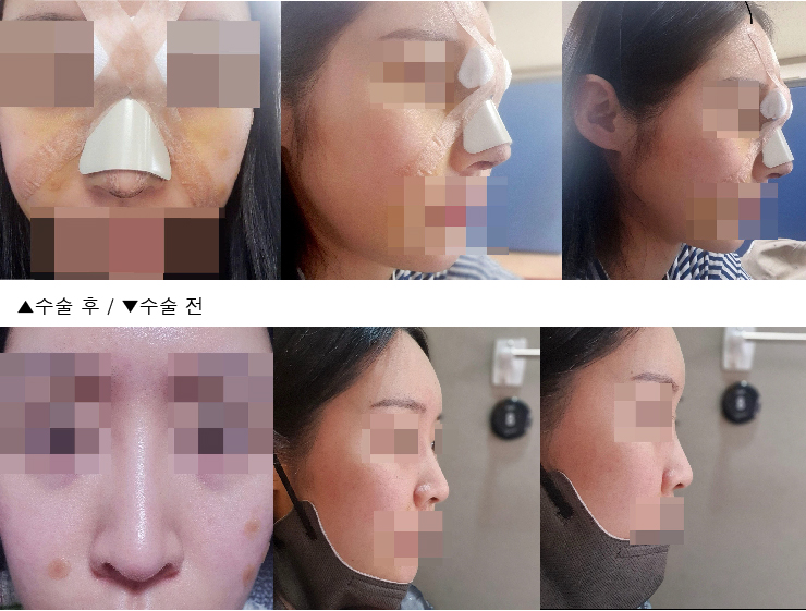 수술후기이미지