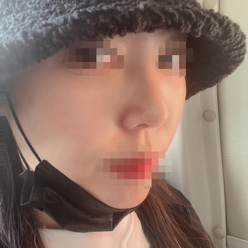 수술후기이미지