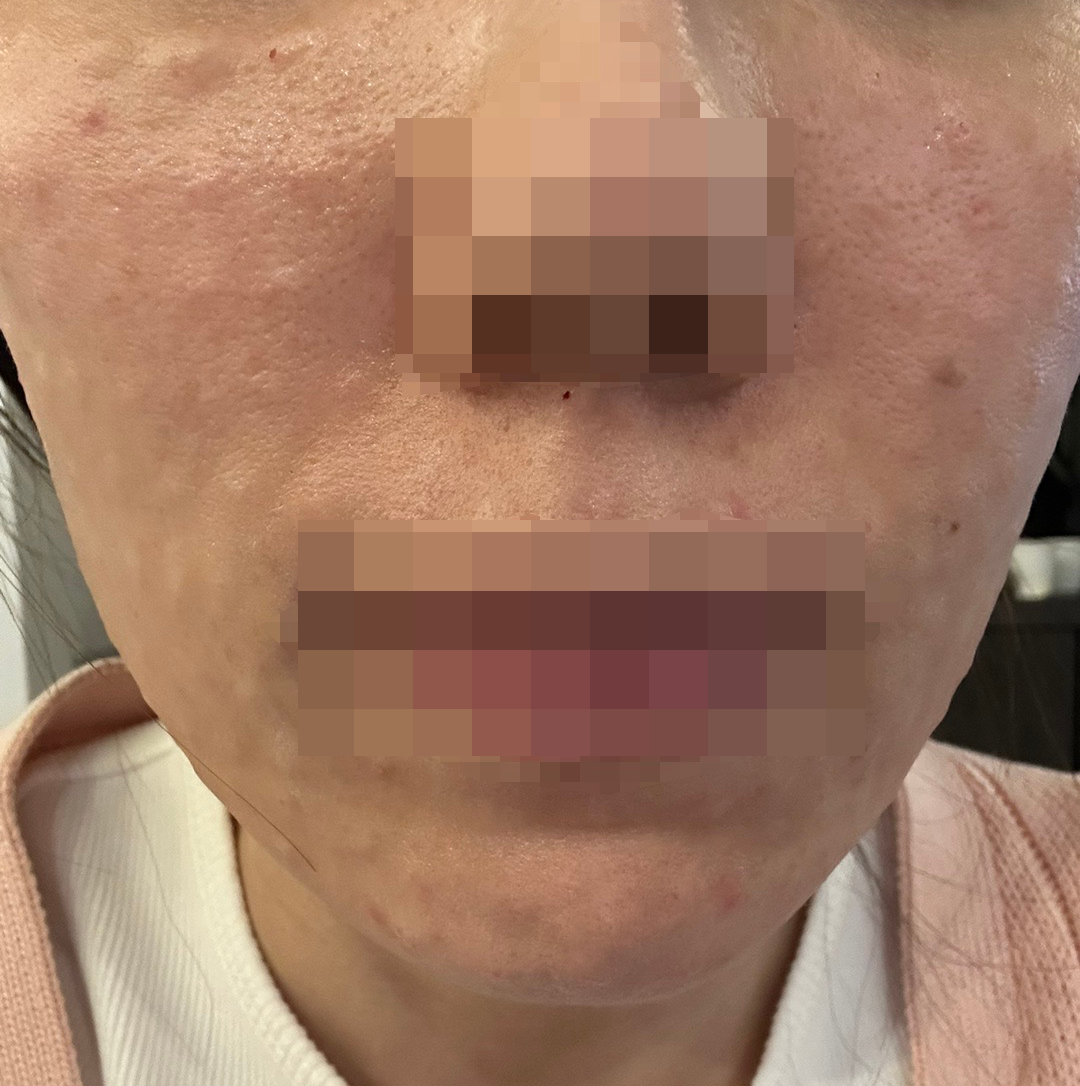 빠른 진행에 만족스러운 시술까지! 부담 없이 받고 왔어요ㅎㅎ