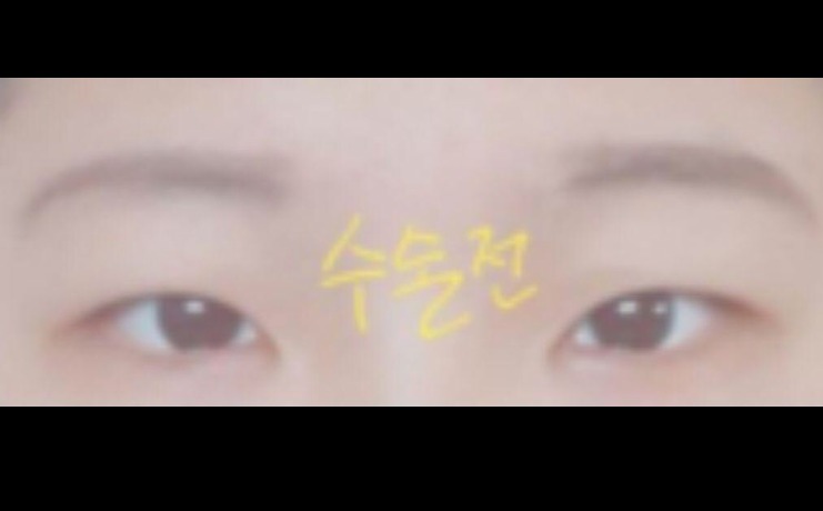 수술후기이미지