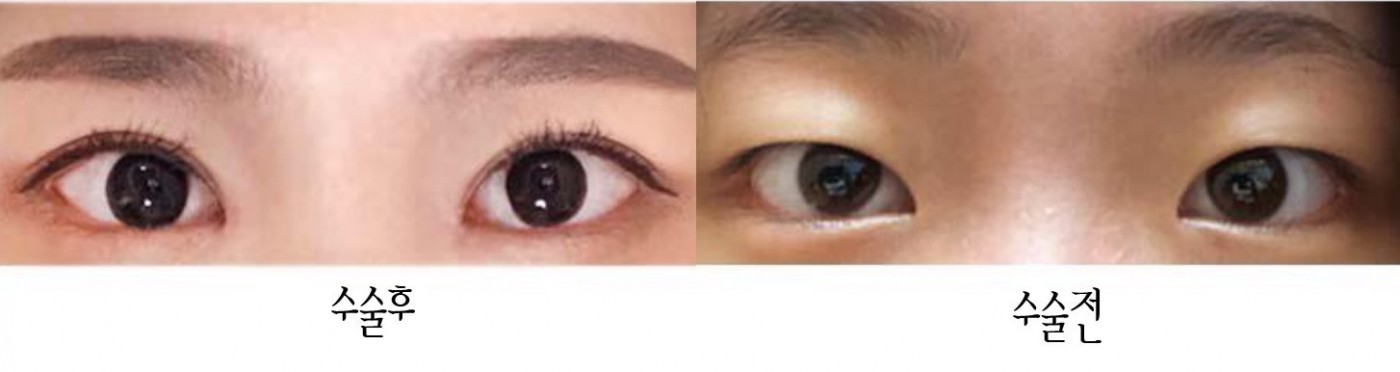 수술후기이미지