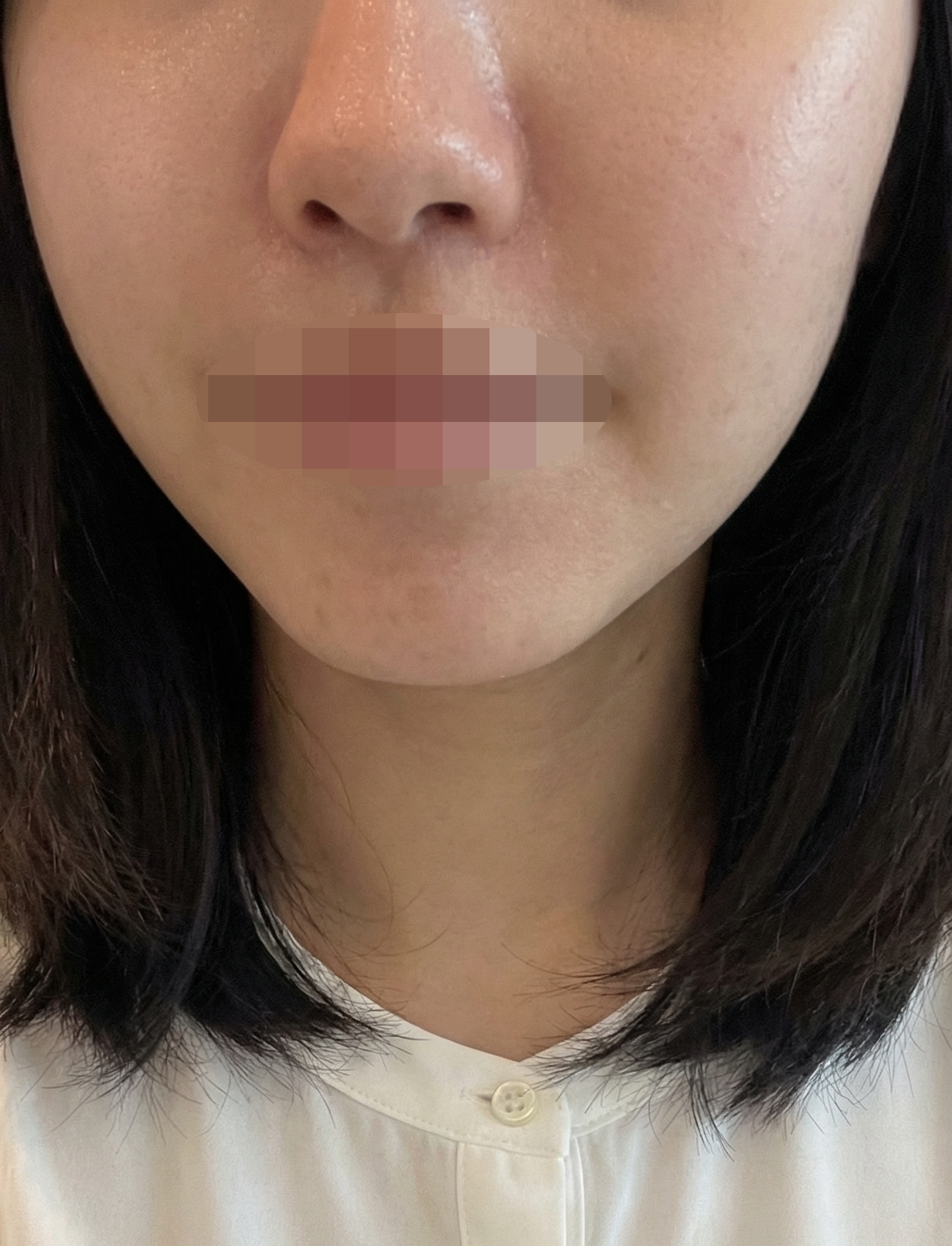 수술후기이미지