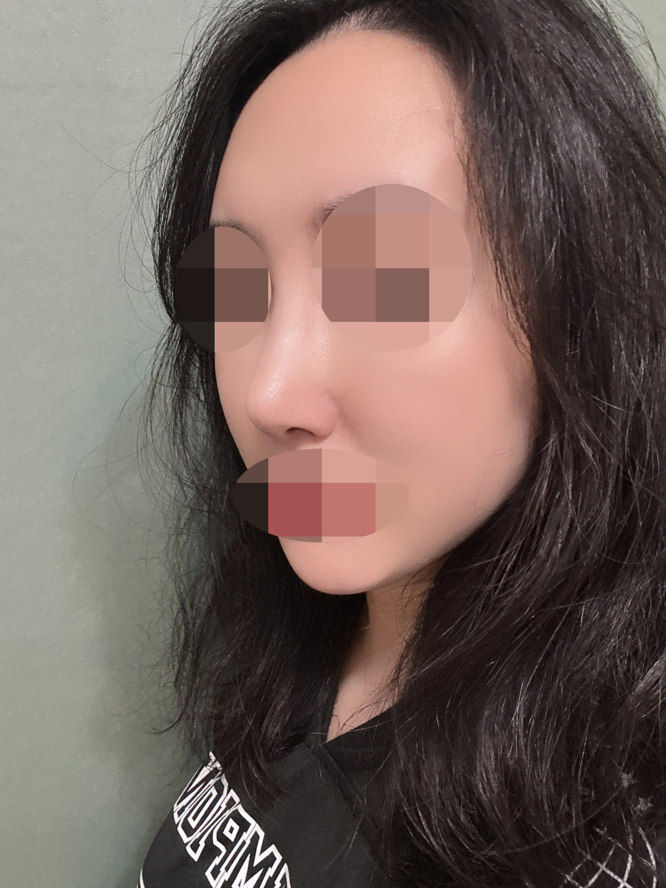 수술후기이미지