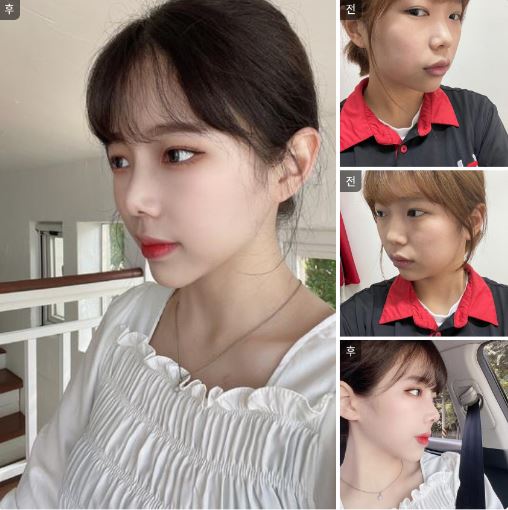 수술후기이미지