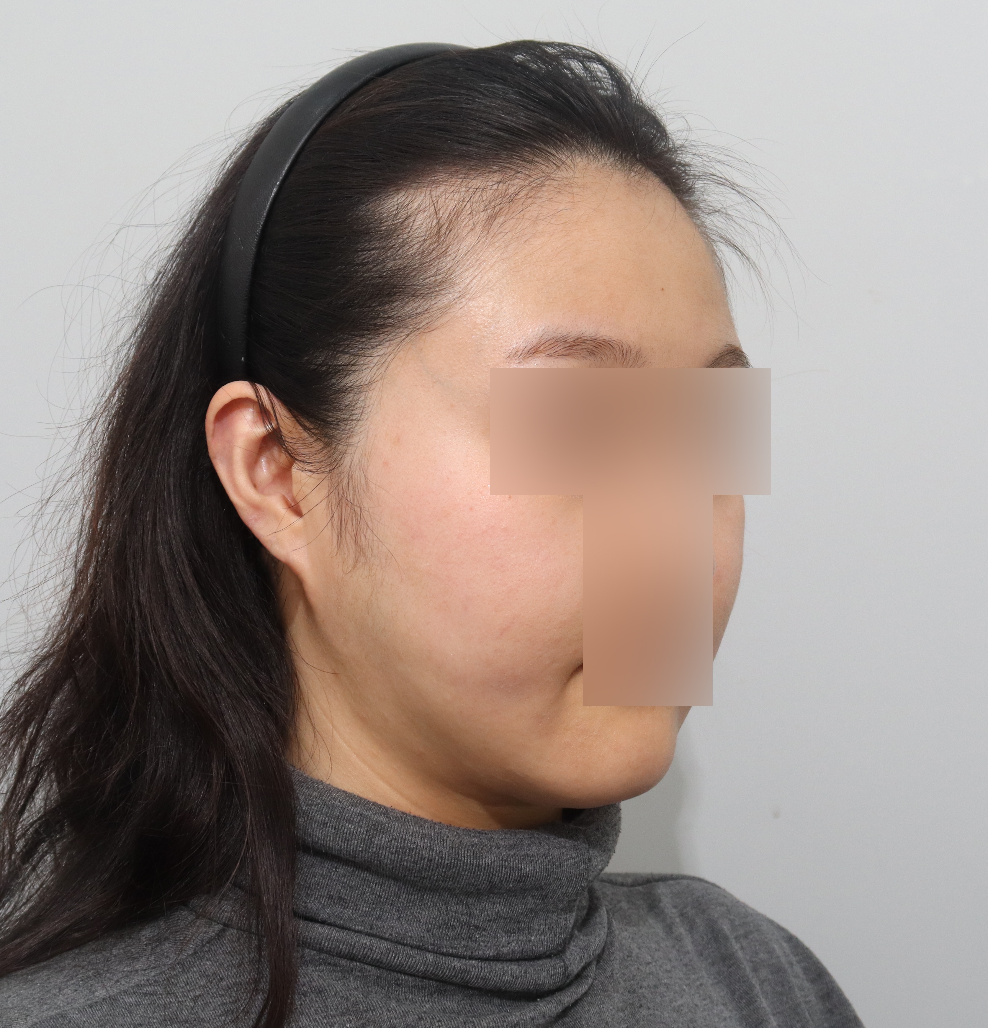 수술후기이미지