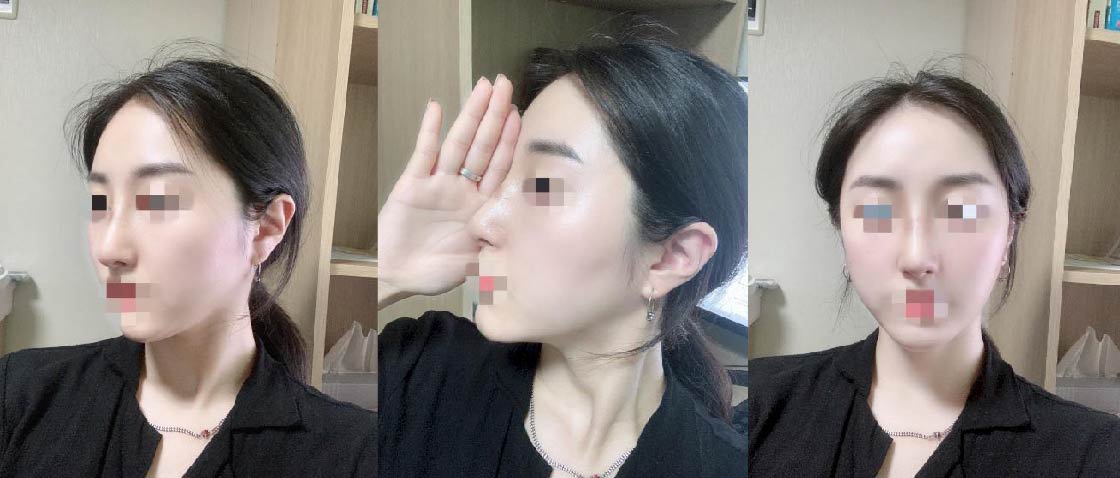 수술후기이미지