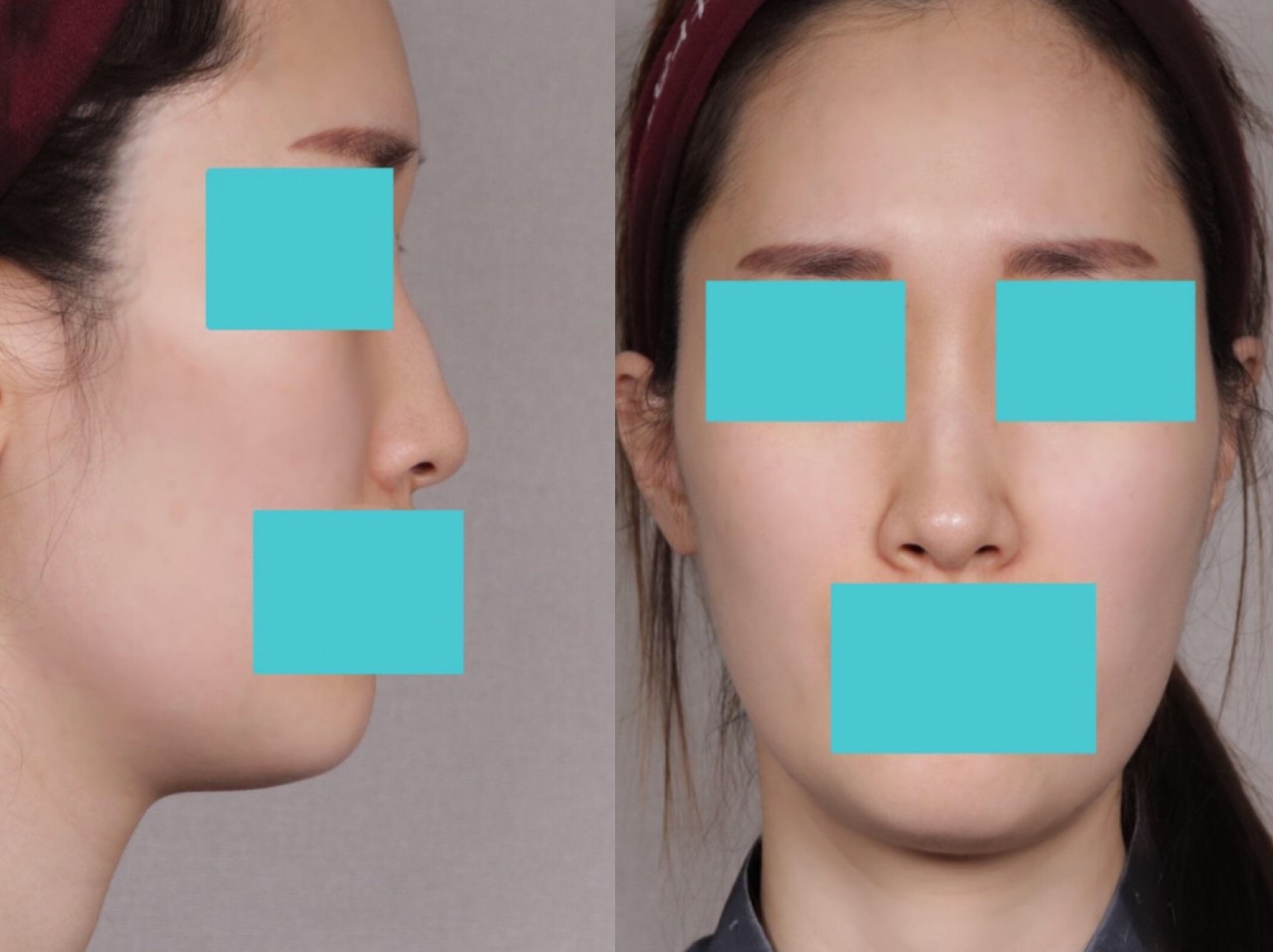 수술후기이미지