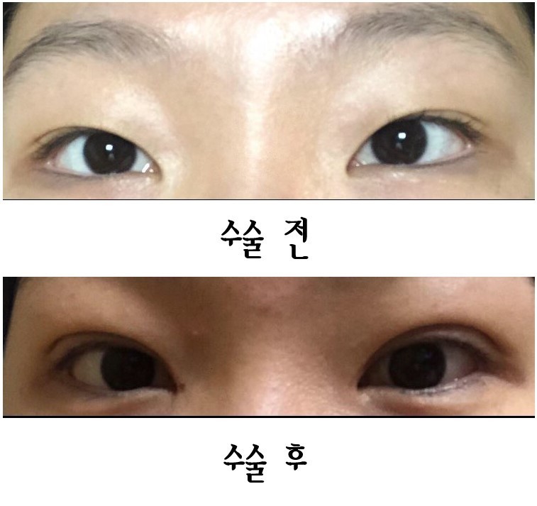 수술후기이미지