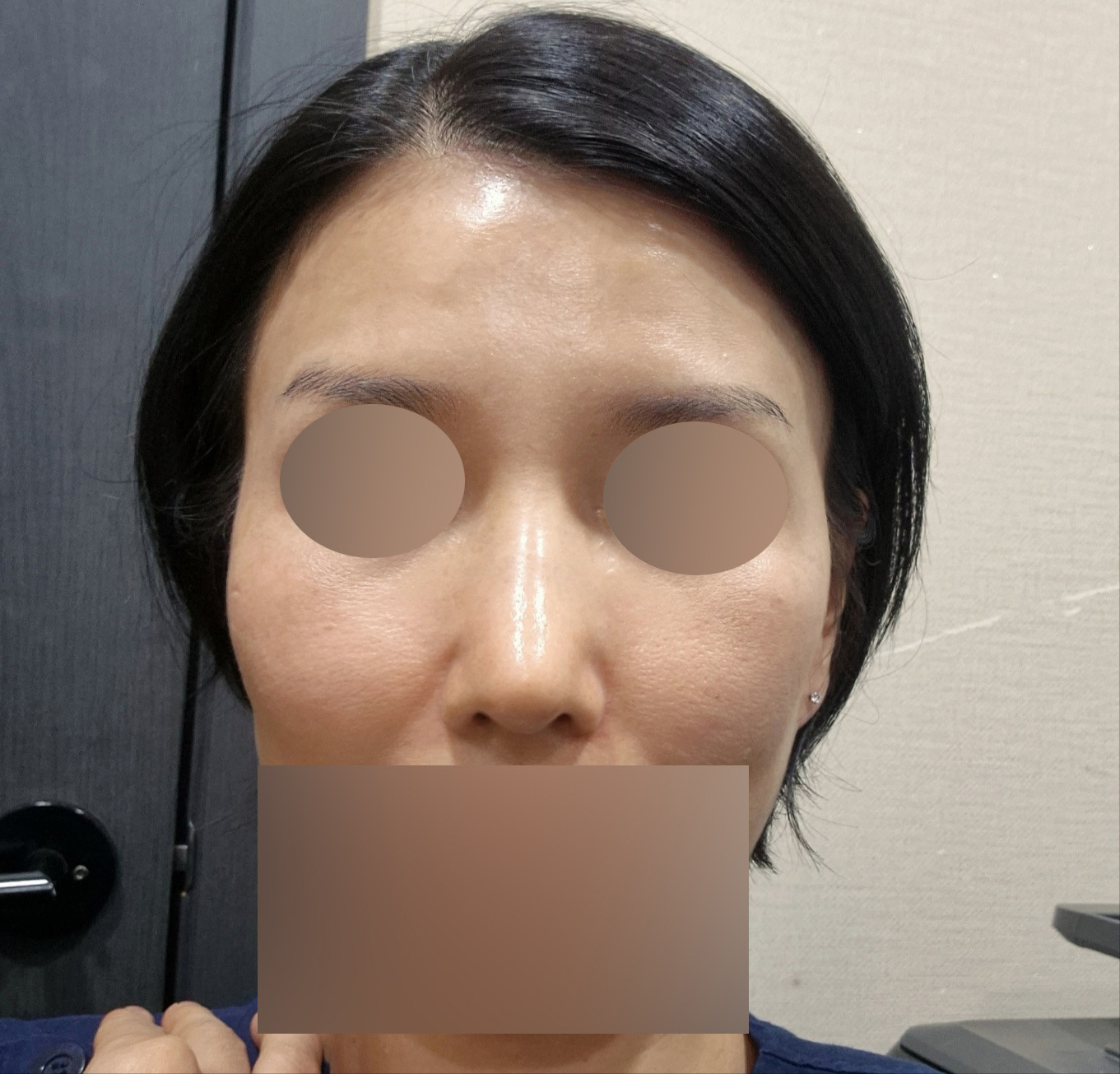 수술후기이미지