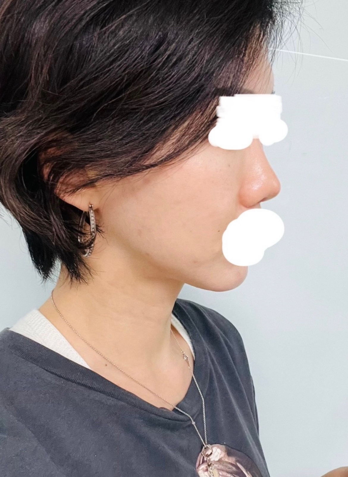 수술후기이미지