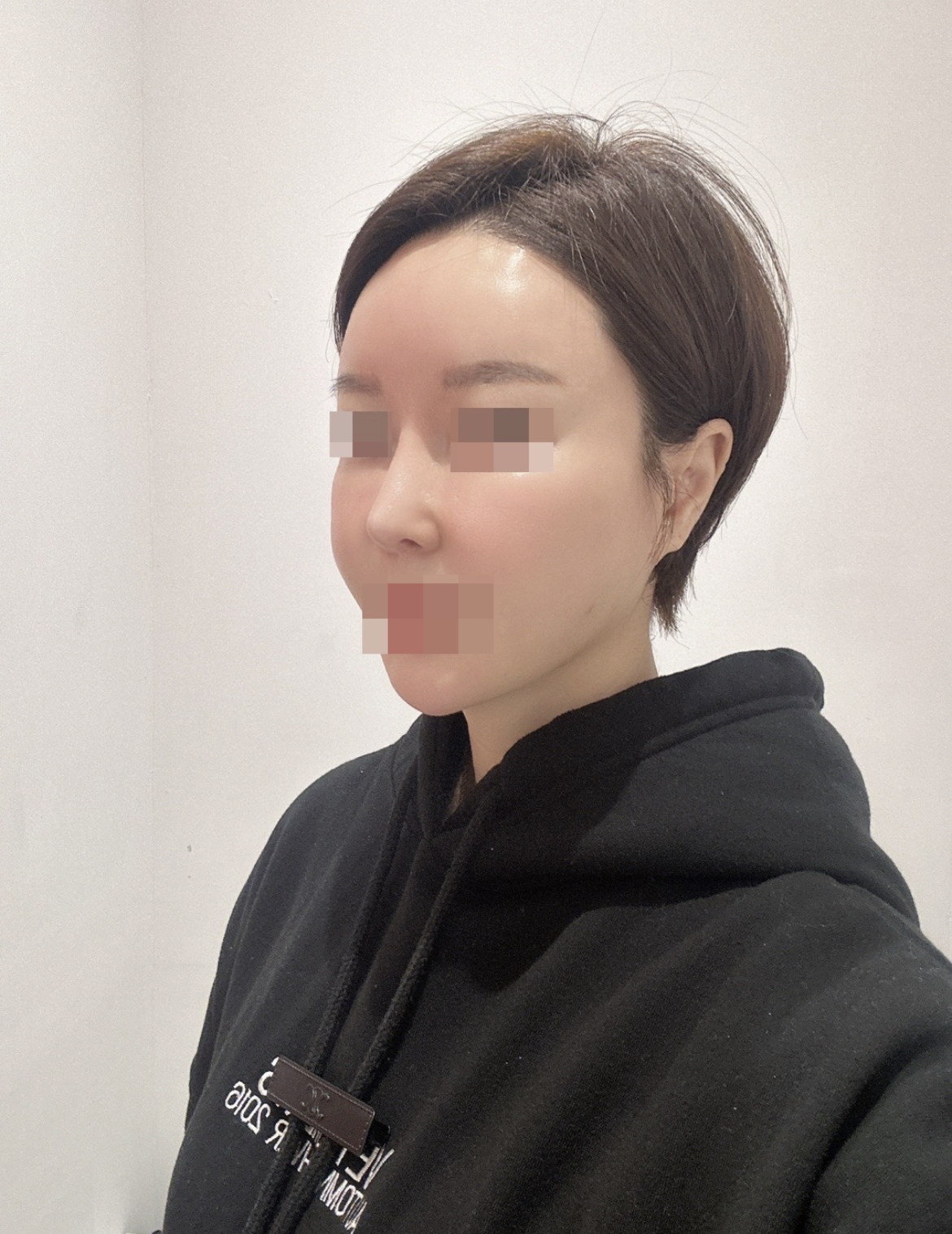 수술후기이미지