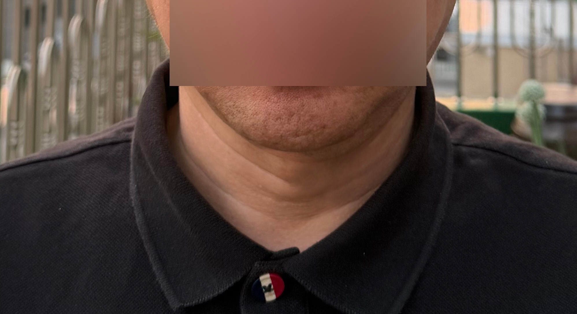 수술후기이미지